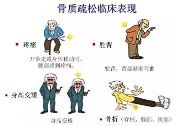 你知道骨質(zhì)疏松癥對(duì)你的生活有哪些影響嗎?